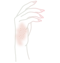 アトピー性皮膚炎